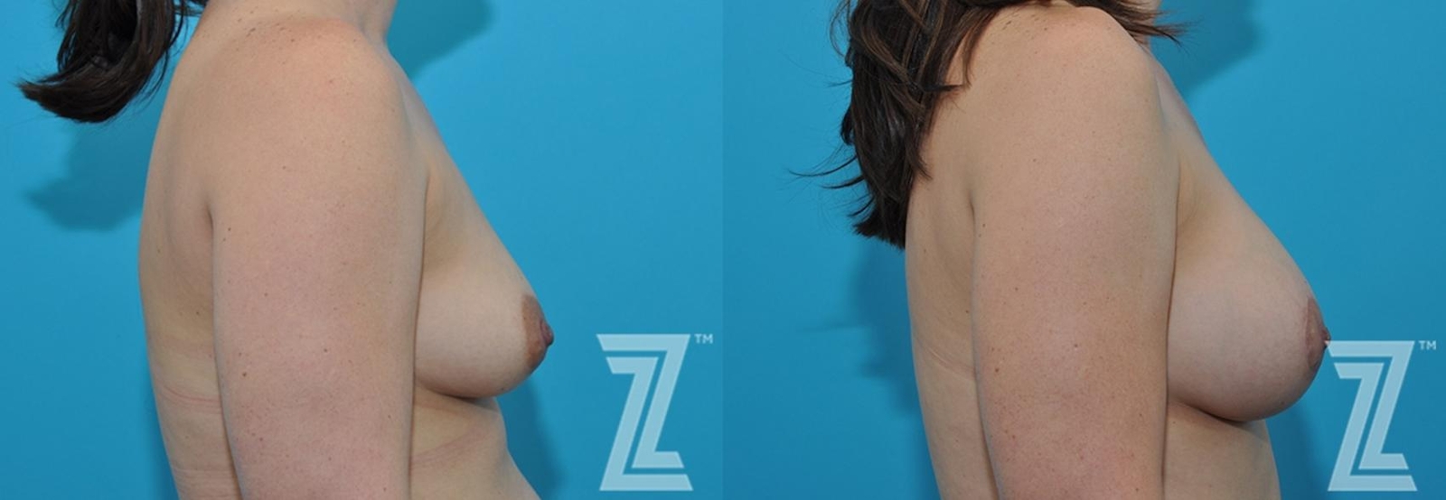 Austin Lateral breast view before & after 3 month post op 39 year old woman mommy make over - The Piazza Center, Austin TX - The Piazza Center