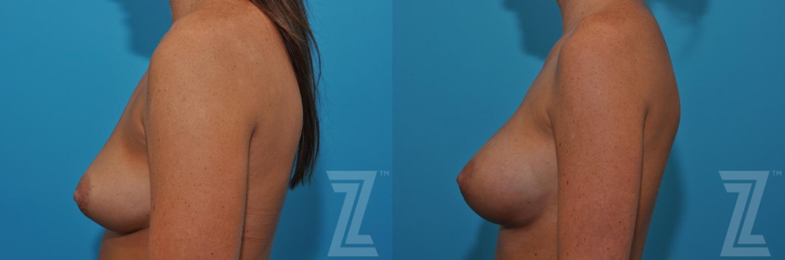 Austin Correction of Breast Asymmetry Before & After Gallery - Patient 132886779 - Image 3 - The Piazza Center