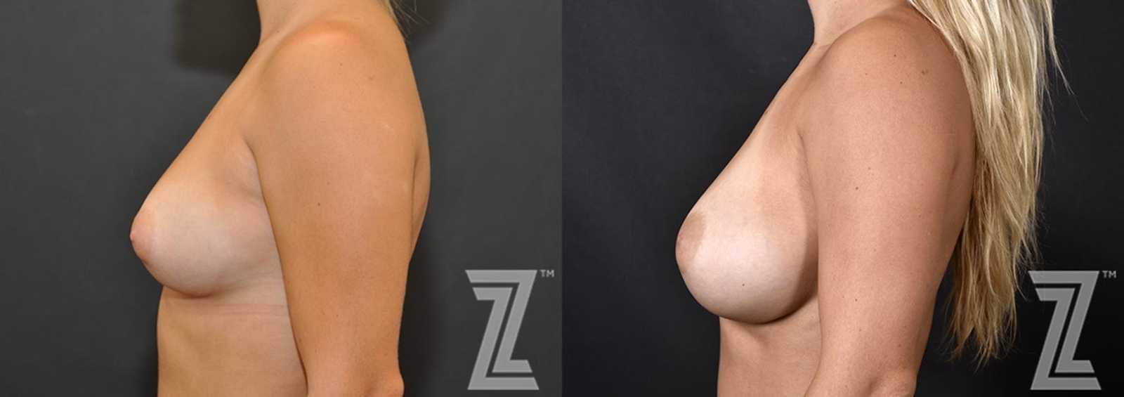 Austin Lateral view of before and after 2 year post op 23 year old woman with breast augmentation - The Piazza Center