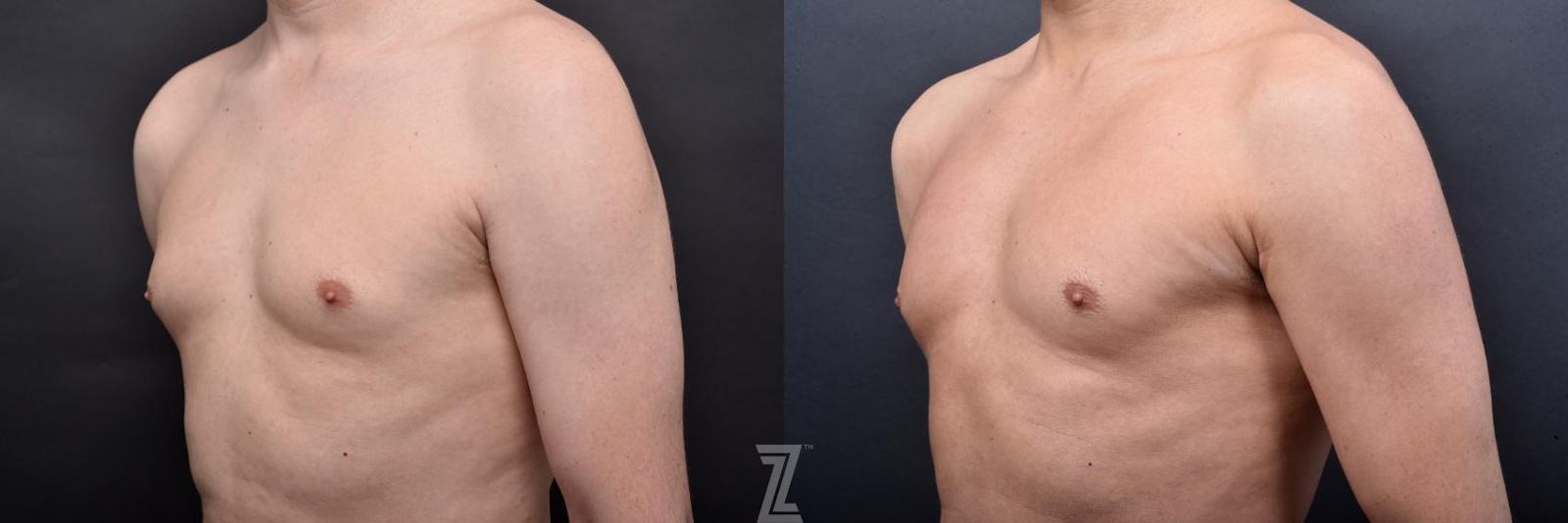 Austin Male Body Contouring Before & After Gallery - Patient 273342 - Image 5 - The Piazza Center