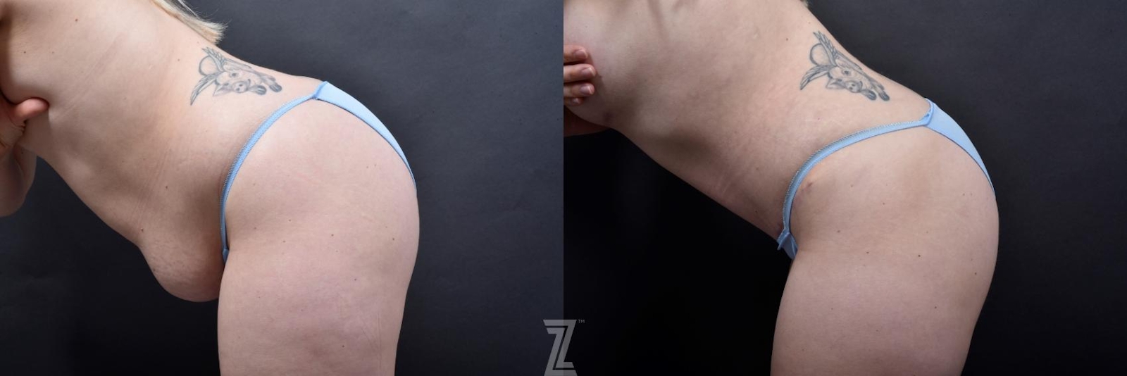 Austin 29-Year-Old Mommy Makeover Before & After by Dr. Rocco Piazza in Austin, Texas - Lateral View of Abdomen in Flexion - The Piazza Center