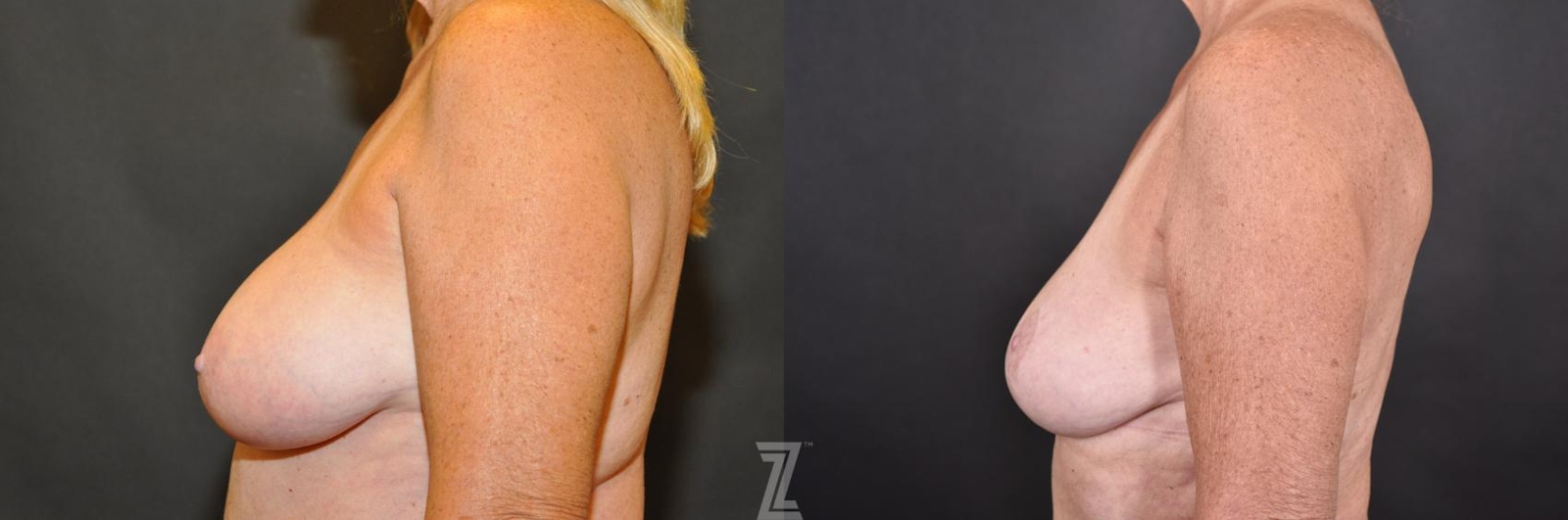 Austin Breast Reduction Before & After Gallery - Patient 132886745 - Image 3 - The Piazza Center