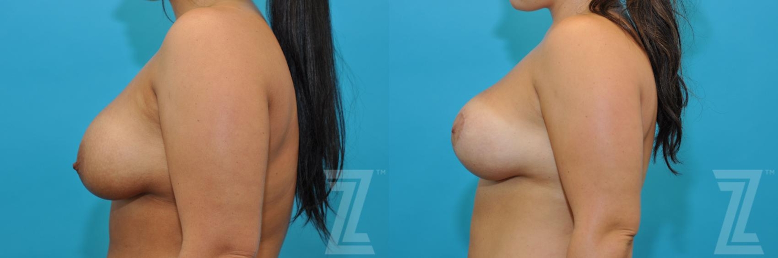 Austin Breast Augmentation Revision Before & After Gallery - Patient 132886591 - Image 3 - The Piazza Center