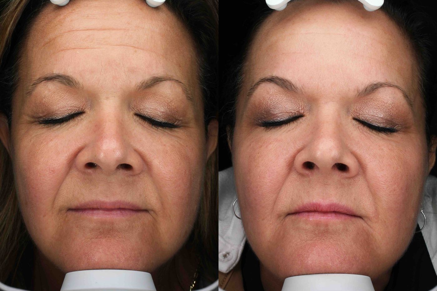 Front view before and after BBL HERO, Moxi laser and Botox in Austin: more even skin tone and softened forehead lines, woman age 54