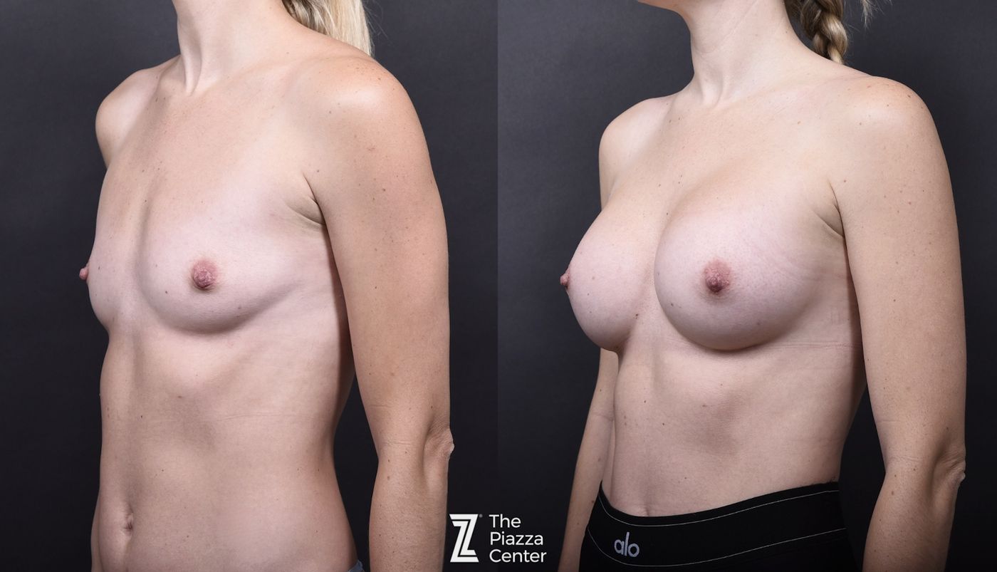 Austin Breast Augmentation Side Comparison - The Piazza Center