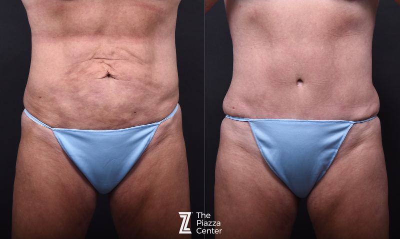 Austin Tummy Tuck Before & After Gallery - Patient 117220 - Image 1 - The Piazza Center