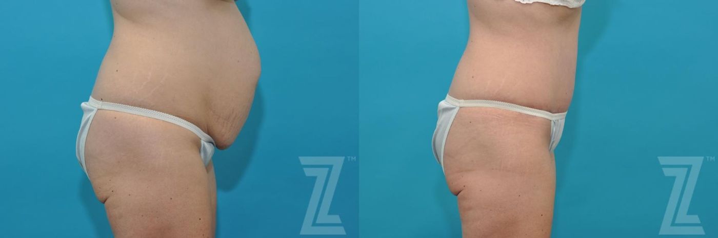 Austin Tummy Tuck Before & After Gallery - Patient 132886822 - Image 4 - The Piazza Center