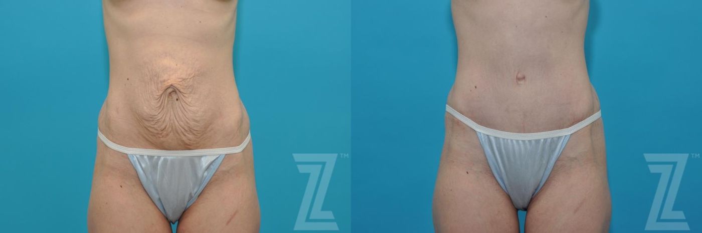 Austin Tummy Tuck Before & After Gallery - Patient 132886867 - Image 1 - The Piazza Center