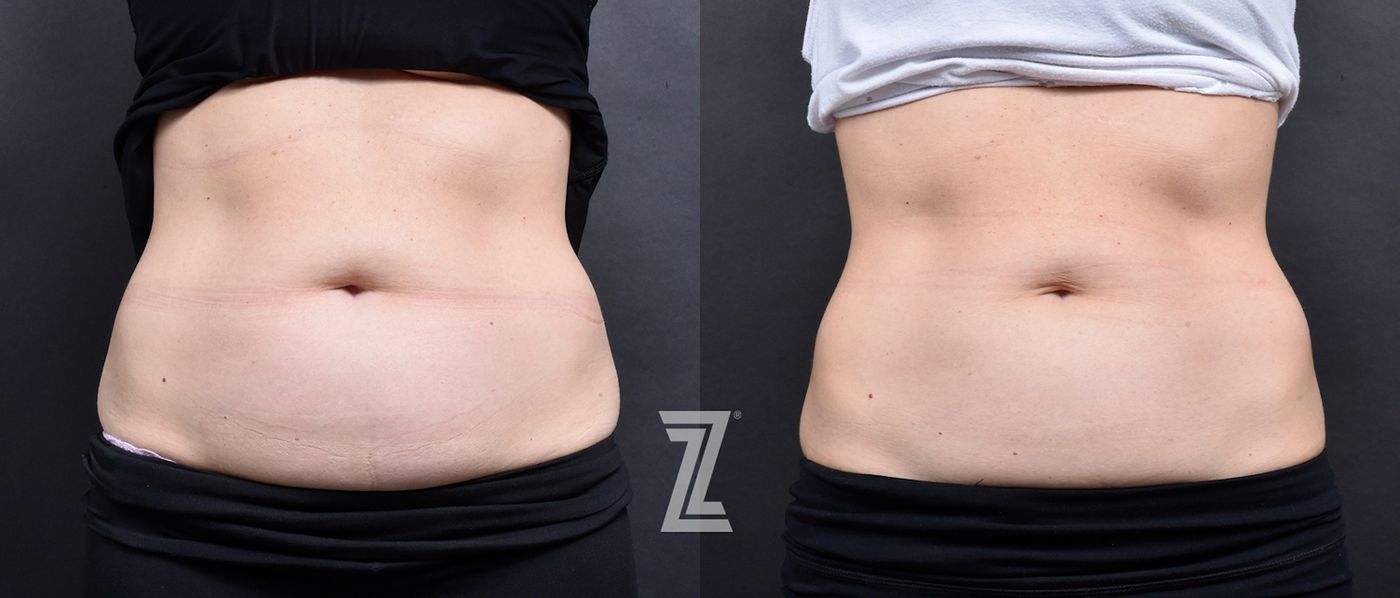 Austin Emsulpt Neo® Before & After Gallery - Patient 408749 - Image 1 - The Piazza Center
