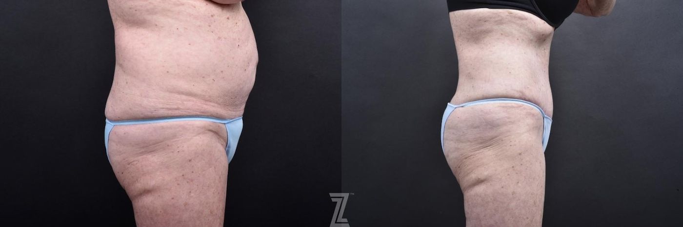 Austin Tummy Tuck Before & After Gallery - Patient 132886796 - Image 3 - The Piazza Center