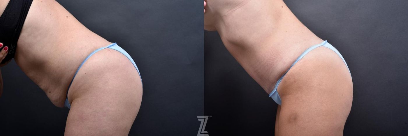 Austin Tummy Tuck Before & After Gallery - Patient 132886865 - Image 3 - The Piazza Center