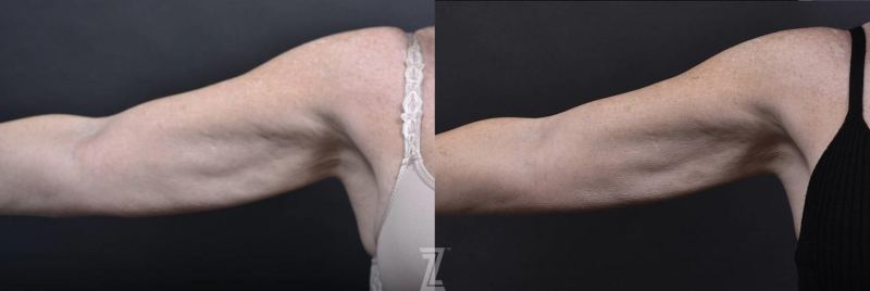 Austin Profound® RF Microneedling Before & After Gallery - Patient 132963569 - Image 1 - The Piazza Center
