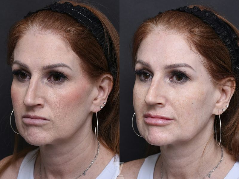 Austin Injectable Fillers Before & After Gallery - Patient 390602 - Image 1 - The Piazza Center