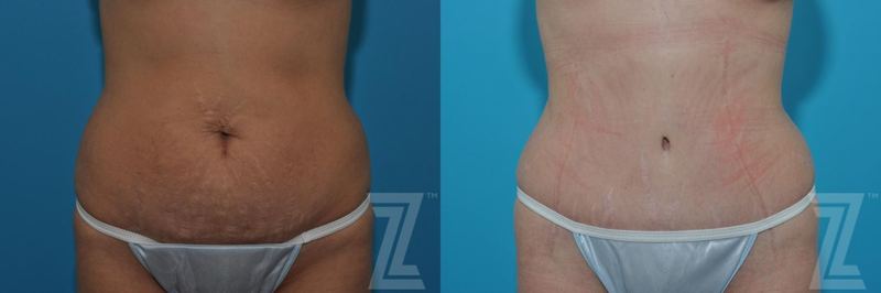 Austin Tummy Tuck Before & After Gallery - Patient 132886879 - Image 1 - The Piazza Center