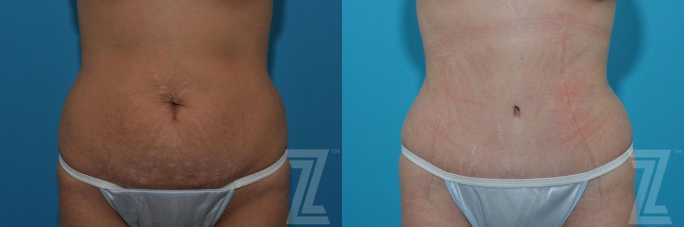 Austin Tummy Tuck Before & After Gallery - Patient 132886879 - Image 1 - The Piazza Center