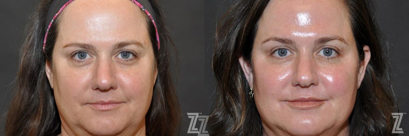 Austin Injectable Fillers Before & After Gallery - Patient 132906324 - Image 1 - The Piazza Center