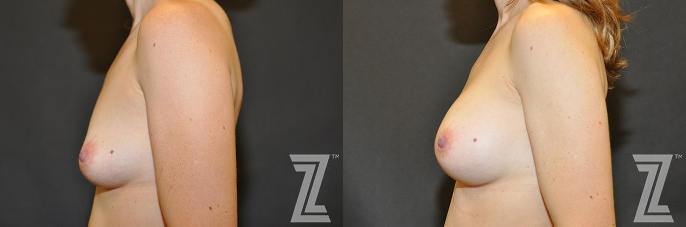 Austin Lateral view before & after of 34 year old woman with Silicone Implants with Cohesive Silicone Gel - The Piazza Center - The Piazza Center