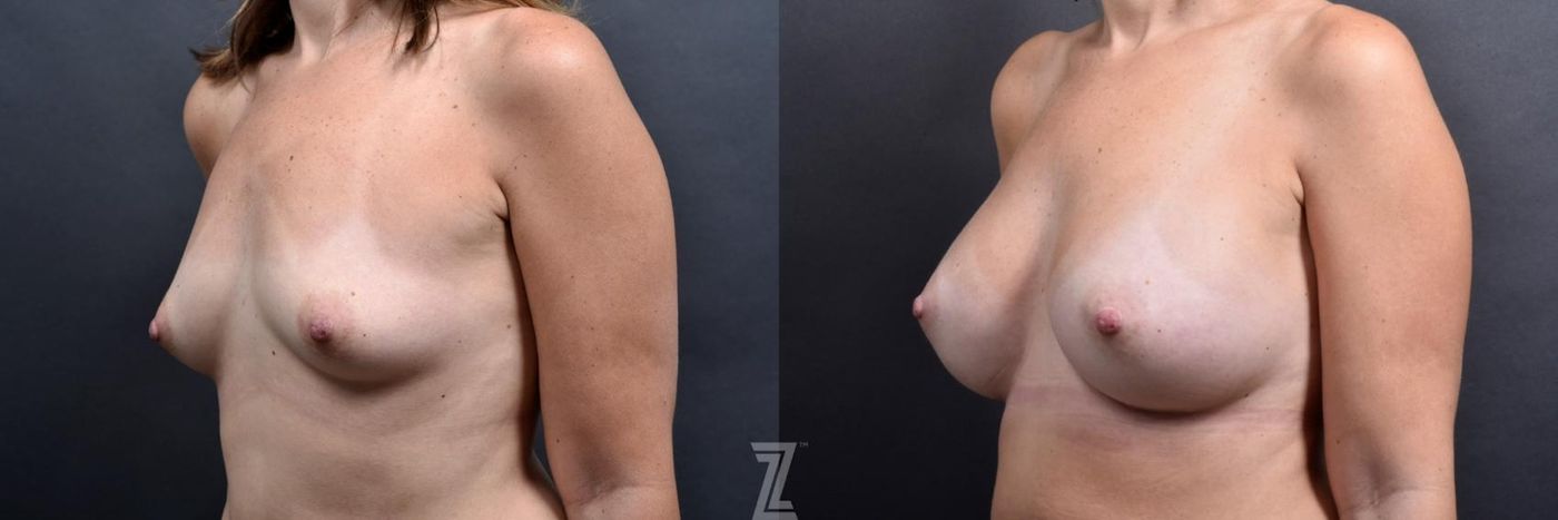 Austin oblique before and after images of 39 year old woman with Silicone Implants with Cohesive Silicone Gel - The Piazza Center - The Piazza Center
