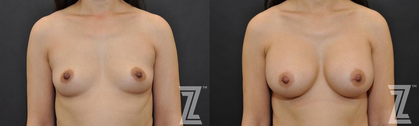 Austin Front view of Before & After image of woman with Silicone Implants with Highly Cohesive Gel (Gummy Bear Implants) - The Piazza Center