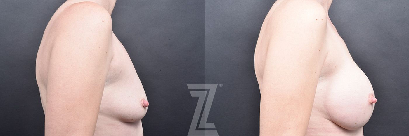 Austin 6 Months Post-Op Before & After Breast Augmentation in Austin, Texas by Dr. Rocco Piazza - Lateral View - The Piazza Center