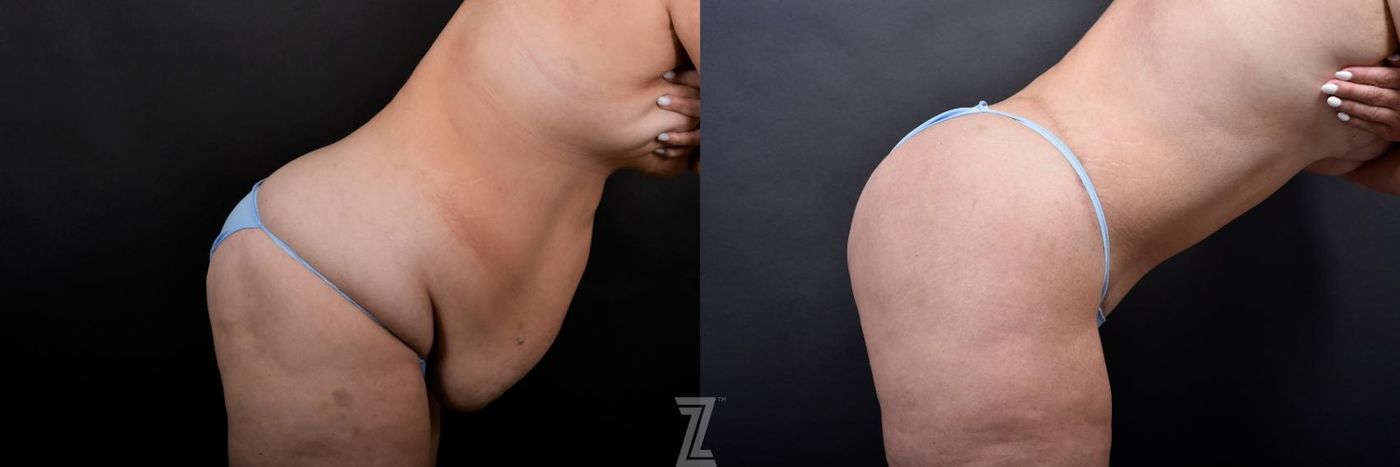 Austin Tummy Tuck Before & After Gallery - Patient 132886815 - Image 5 - The Piazza Center
