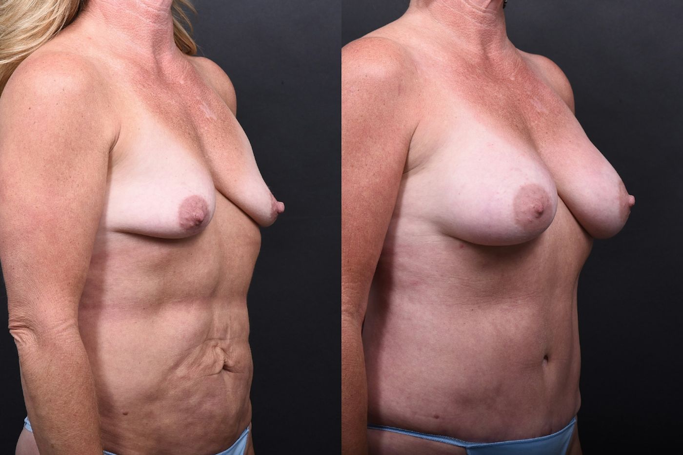 Austin Liposuction Before & After Gallery - Patient 311956 - Image 4 - The Piazza Center