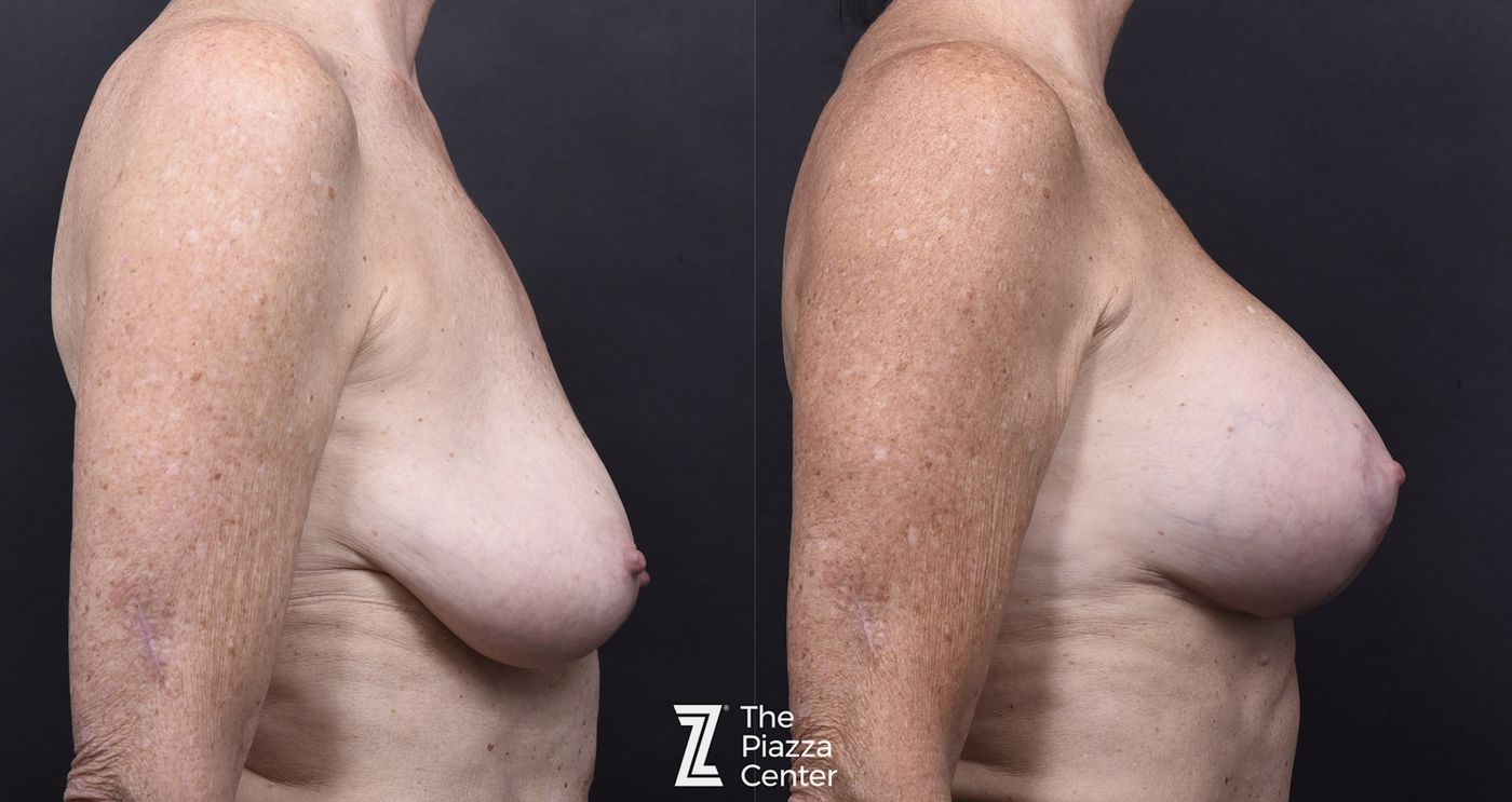 Austin Motiva Implants Before & After Gallery - Patient 406198 - Image 3 - The Piazza Center