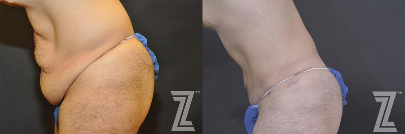 Austin Tummy Tuck Before & After Gallery - Patient 132886870 - Image 3 - The Piazza Center