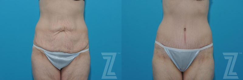 Austin Tummy Tuck Before & After Gallery - Patient 132886817 - Image 1 - The Piazza Center