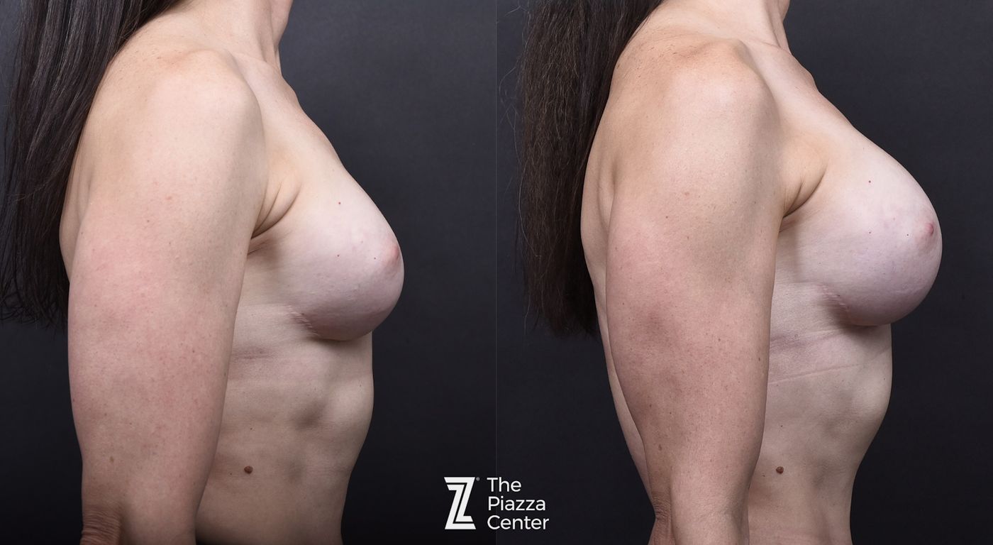 Austin Breast Augmentation Before & After Gallery - Patient 276383 - Image 4 - The Piazza Center