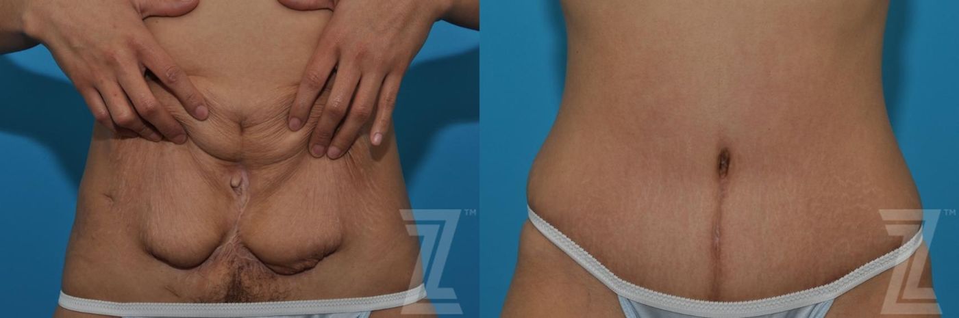 Austin Tummy Tuck Before & After Gallery - Patient 132886797 - Image 6 - The Piazza Center