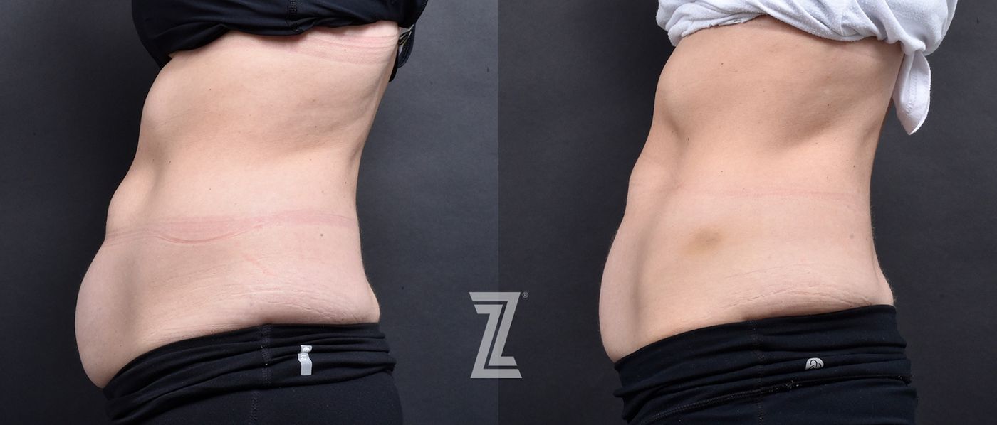 Austin Emsulpt Neo® Before & After Gallery - Patient 408749 - Image 2 - The Piazza Center