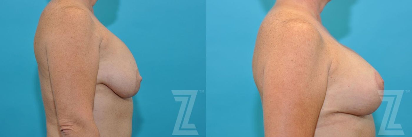 Austin Breast Augmentation Revision Before & After Gallery - Patient 132886540 - Image 5 - The Piazza Center
