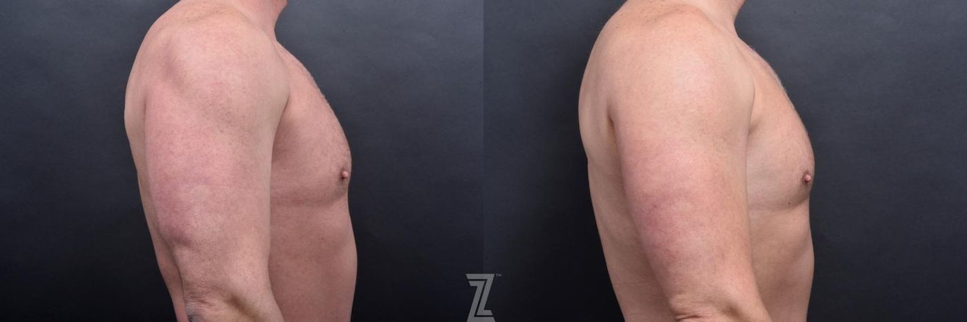 Austin Male Body Contouring Before & After Gallery - Patient 173307 - Image 7 - The Piazza Center