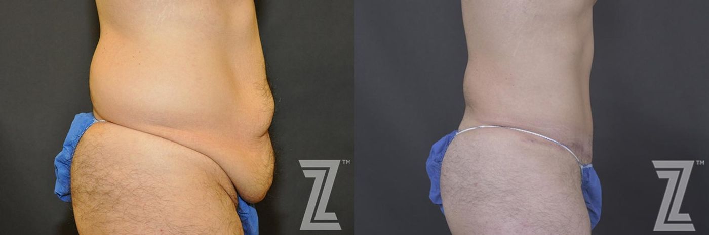 Austin Tummy Tuck Before & After Gallery - Patient 132886870 - Image 6 - The Piazza Center