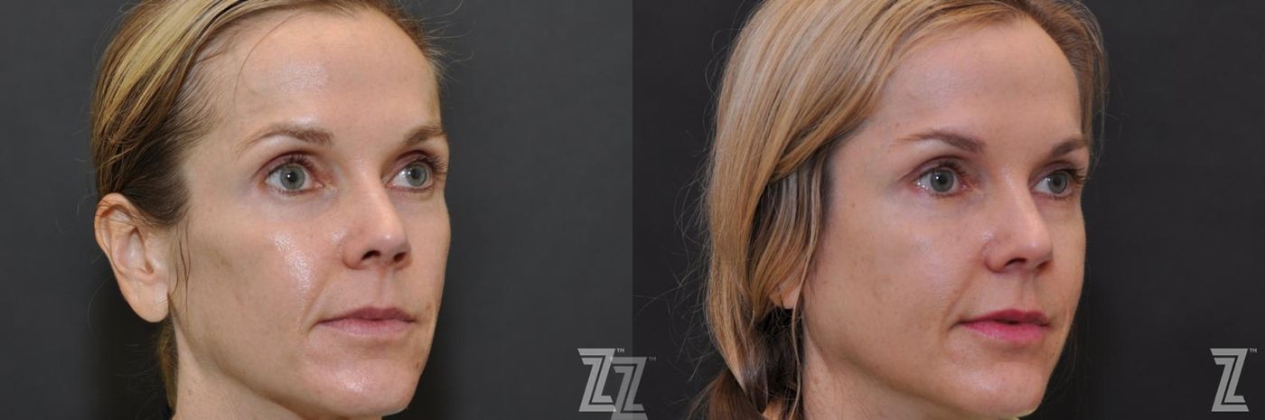 Austin Sculptra® Before & After Gallery - Patient 132963136 - Image 3 - The Piazza Center