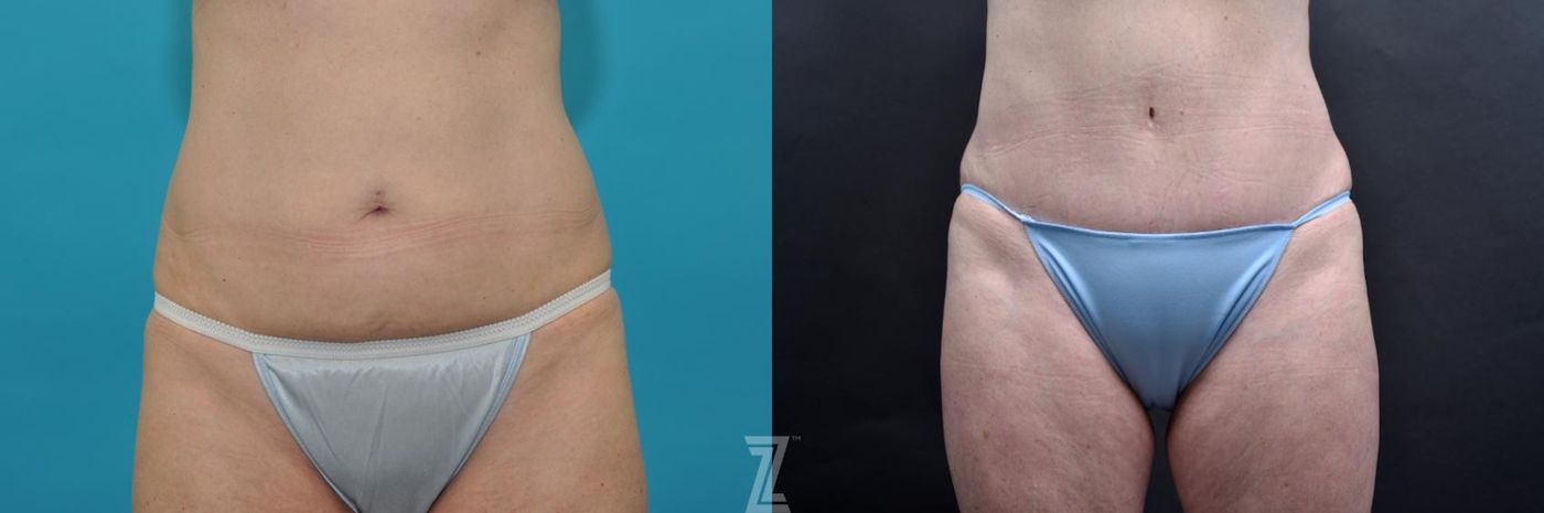 Austin Frontal abdominal view 7 year post op mommy makeover - The Piazza Center, Austin Tx - The Piazza Center