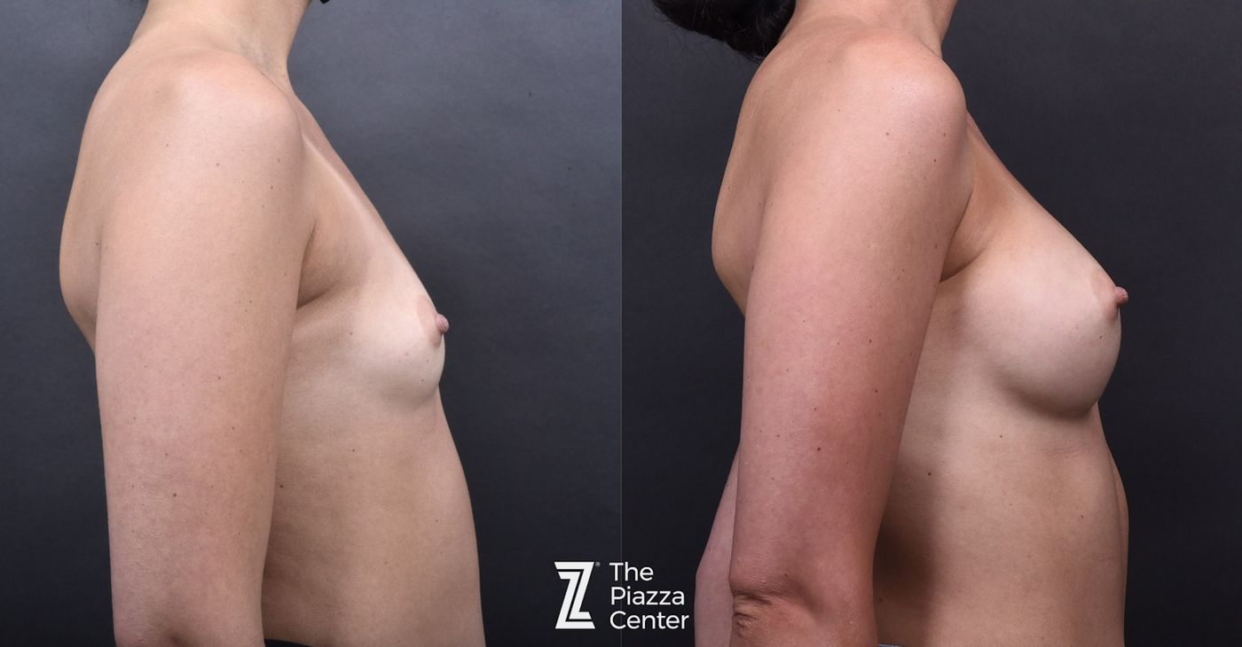 Austin Breast Augmentation Before & After Gallery - Patient 790705 - Image 3 - The Piazza Center
