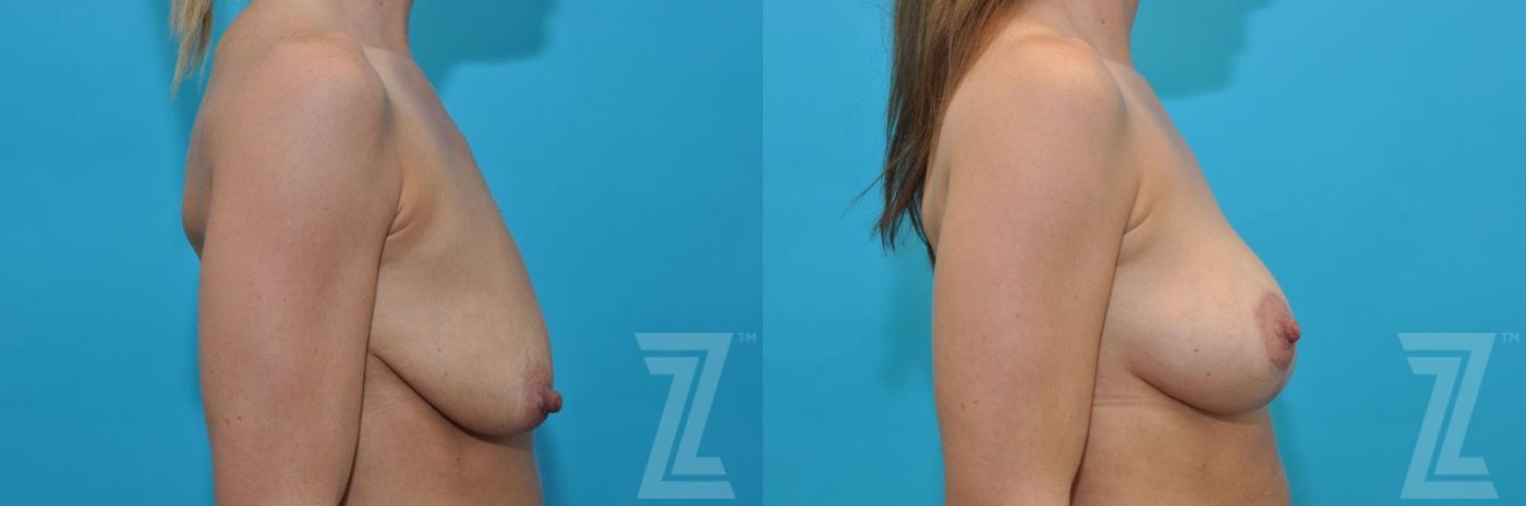 Austin Breast Augmentation With a Breast Lift Before & After Gallery - Patient 132791091 - Image 5 - The Piazza Center