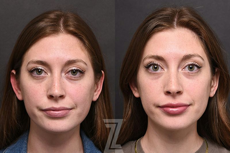Austin Injectable Fillers Before & After Gallery - Patient 922179 - Image 1 - The Piazza Center