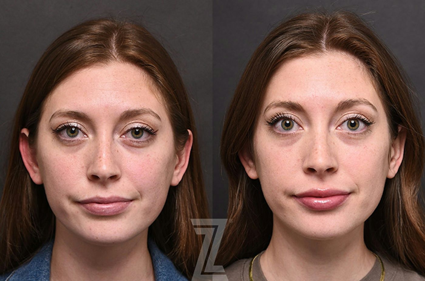 Austin Injectable Fillers Before & After Gallery - Patient 922179 - Image 1 - The Piazza Center