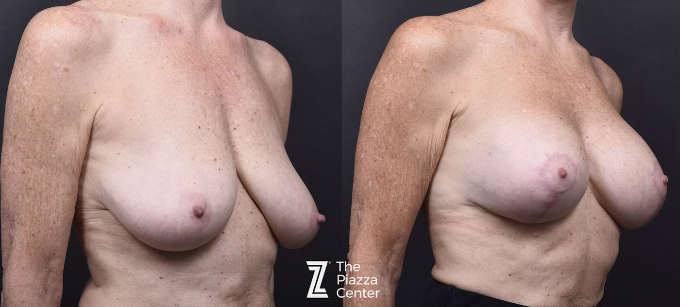Austin Motiva Implants Before & After Gallery - Patient 406198 - Image 2 - The Piazza Center