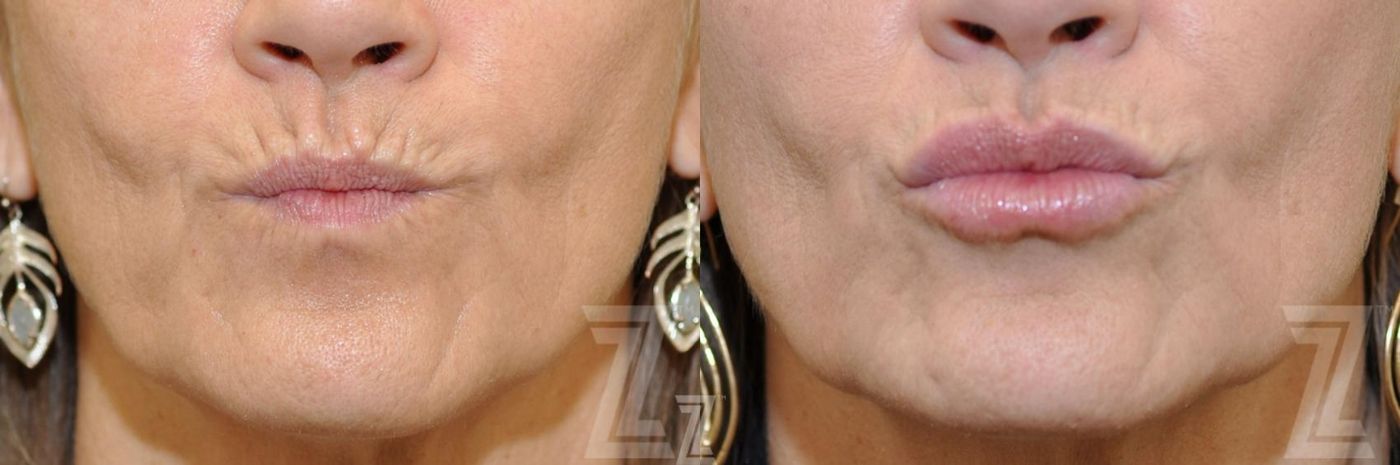Austin Injectable Fillers Before & After Gallery - Patient 132963127 - Image 2 - The Piazza Center
