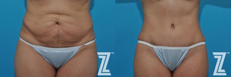 Austin Tummy Tuck Before & After Gallery - Patient 132886863 - Image 1 - The Piazza Center
