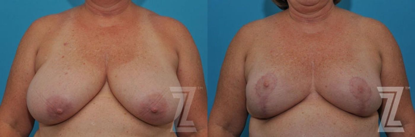Austin Breast Reduction Before & After Gallery - Patient 132886617 - Image 1 - The Piazza Center
