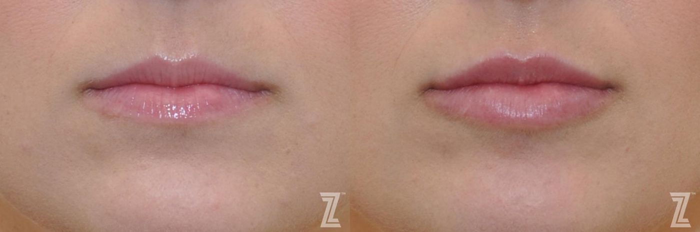 Austin Injectable Fillers Before & After Gallery - Patient 132963115 - Image 1 - The Piazza Center