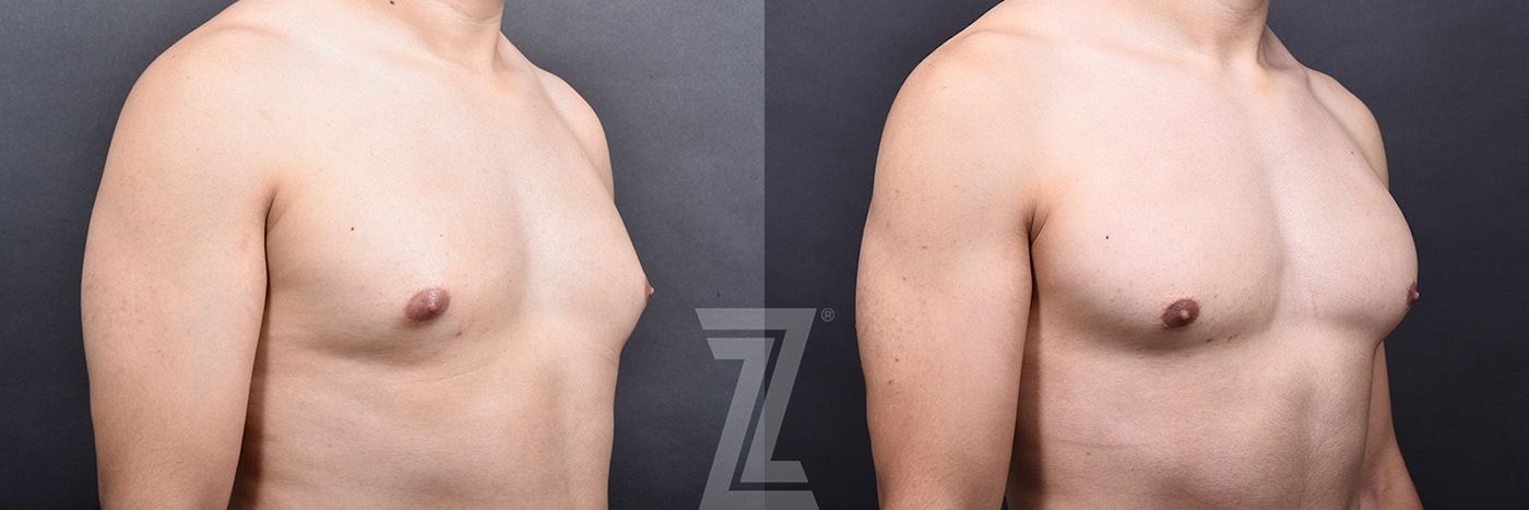 Austin Gynecomastia/Male Breast Reduction Before & After Gallery - Patient 105962 - Image 2 - The Piazza Center