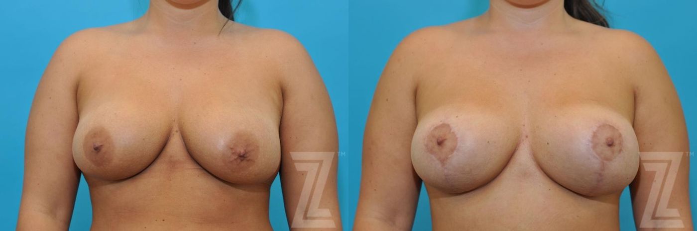 Austin Breast Augmentation Revision Before & After Gallery - Patient 132886591 - Image 1 - The Piazza Center
