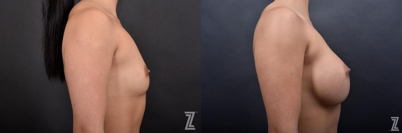Austin Lateral View Before & After Breast Augmentation of 25-Year-Old Female Patient at The Piazza Center in Austin - Dr. Piazza - The Piazza Center