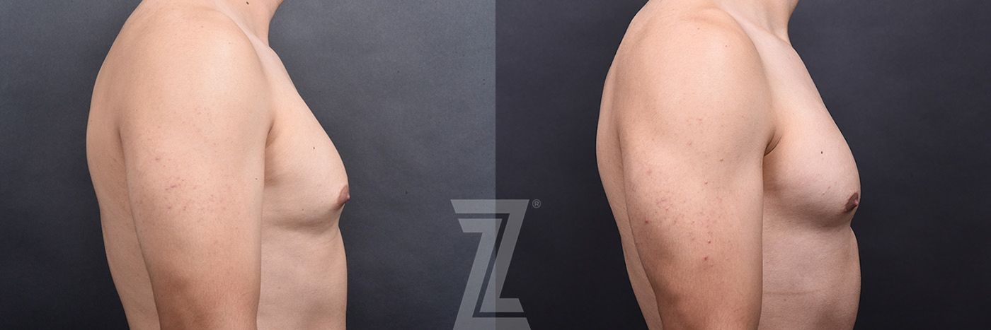 Austin Gynecomastia/Male Breast Reduction Before & After Gallery - Patient 105962 - Image 3 - The Piazza Center